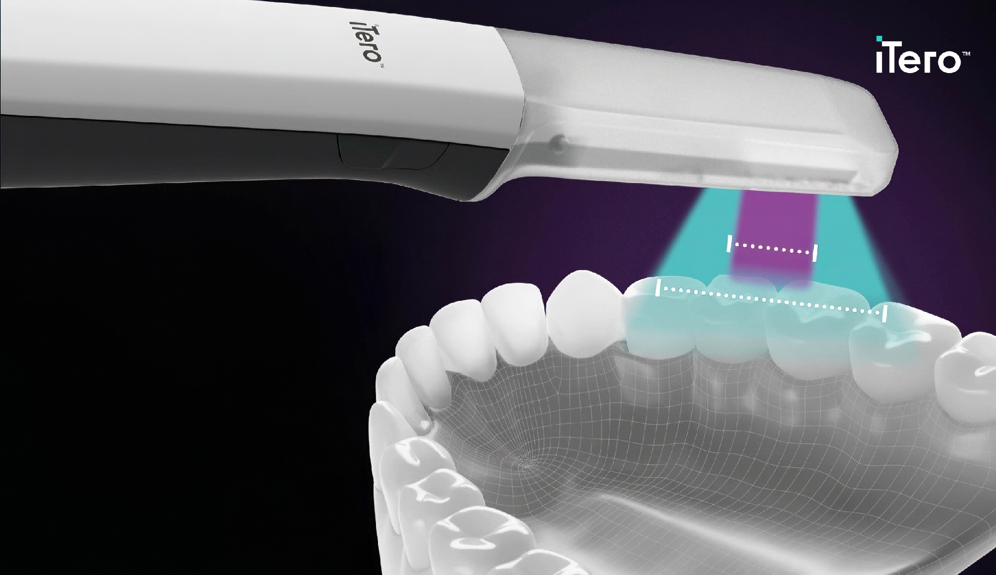 iTero lumina Cart Erweiterte Sichtfeld-Technologie - Scanning in Aktion